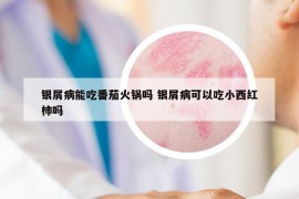 銀屑病能吃番茄火鍋嗎 銀屑病可以吃小西紅柿嗎
