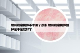 銀屑病扁桃體手術(shù)用了激素 銀屑病扁桃體割掉是不是就好了