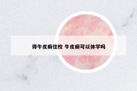 得牛皮癬住校 牛皮癬可以休學(xué)嗎