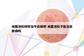 米醋泡松樹籽治牛皮癬吧 米醋泡松子能治皮膚病嗎