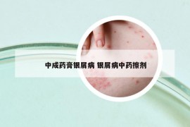 中成藥膏銀屑病 銀屑病中藥擦劑