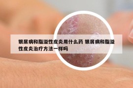 銀屑病和脂溢性皮炎用什么藥 銀屑病和脂溢性皮炎治療方法一樣嗎