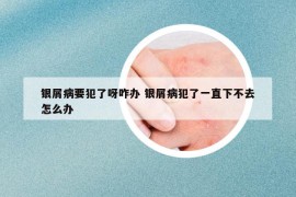 銀屑病要犯了呀咋辦 銀屑病犯了一直下不去怎么辦