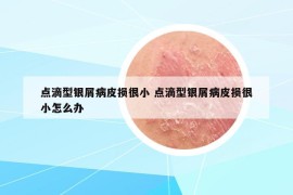 點(diǎn)滴型銀屑病皮損很小 點(diǎn)滴型銀屑病皮損很小怎么辦
