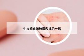 牛皮癬盒裝膠囊和抹的一起