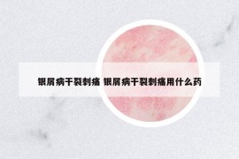 銀屑病干裂刺痛 銀屑病干裂刺痛用什么藥