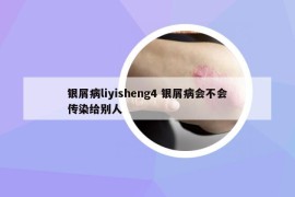 銀屑病liyisheng4 銀屑病會不會傳染給別人