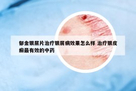 郁金銀屑片治療銀屑病效果怎么樣 治療銀皮癬最有效的中藥