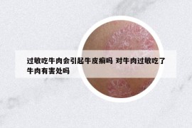 過敏吃牛肉會引起牛皮癬嗎 對牛肉過敏吃了牛肉有害處嗎