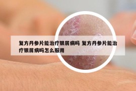 復(fù)方丹參片能治療銀屑病嗎 復(fù)方丹參片能治療銀屑病嗎怎么服用