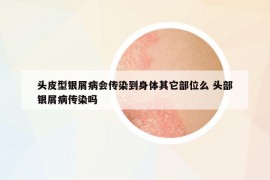 頭皮型銀屑病會(huì)傳染到身體其它部位么 頭部銀屑病傳染嗎
