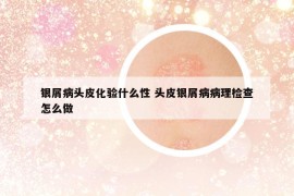 銀屑病頭皮化驗什么性 頭皮銀屑病病理檢查怎么做