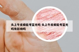 頭上牛皮癬能考藍(lán)光嗎 頭上牛皮癬能考藍(lán)光嗎有影響嗎