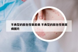 不典型的膿包性銀屑病 不典型的膿包性銀屑病圖片