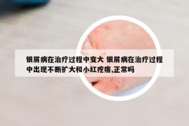 銀屑病在治療過(guò)程中變大 銀屑病在治療過(guò)程中出現(xiàn)不斷擴(kuò)大和小紅疙瘩,正常嗎