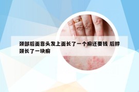 頸部后面靠頭發(fā)上面長了一個癬還要錢 后脖頸長了一塊癬