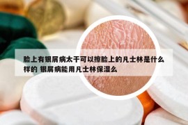 臉上有銀屑病太干可以擦臉上的凡士林是什么樣的 銀屑病能用凡士林保濕么