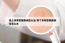 患上尋常型銀屑病怎么治 得了尋常型銀屑病該怎么辦