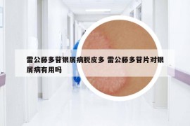 雷公藤多苷銀屑病脫皮多 雷公藤多苷片對銀屑病有用嗎