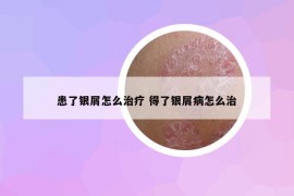 患了銀屑怎么治療 得了銀屑病怎么治
