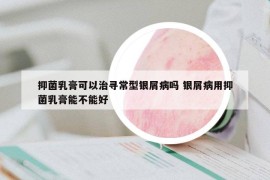 抑菌乳膏可以治尋常型銀屑病嗎 銀屑病用抑菌乳膏能不能好