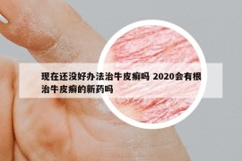 現(xiàn)在還沒好辦法治牛皮癬嗎 2020會(huì)有根治牛皮癬的新藥嗎