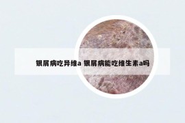 銀屑病吃異維a 銀屑病能吃維生素a嗎