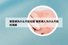 銀屑病為什么不能吃糖 銀屑病人為什么不能吃海鮮