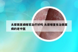 太原銀屑病哪家治療好嗎 太原哪里有治銀屑病的老中醫(yī)
