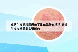 點狀牛皮癬按壓患處不出血是什么情況 點狀牛皮皮癬是怎么引起的