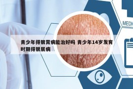 青少年得銀霄病能治好嗎 青少年14歲發(fā)育時(shí)期得銀屑病