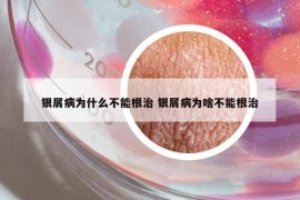 銀屑病為什么不能根治 銀屑病為啥不能根治