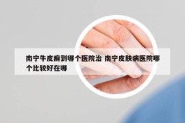 南寧牛皮癬到哪個醫(yī)院治 南寧皮膚病醫(yī)院哪個比較好在哪