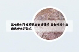 三七粉對(duì)牛皮癬患者有好處嗎 三七粉對(duì)牛皮癬患者有好處嗎