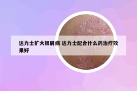 達(dá)力士擴(kuò)大銀屑病 達(dá)力士配合什么藥治療效果好