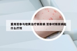 重用苦參與地黃治療銀屑病 苦參對(duì)銀屑病起什么療效