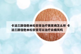 卡泊三醇倍他米松軟膏治療銀屑病怎么樣 卡泊三醇倍他米松軟膏可以治療白癜風(fēng)嗎