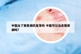 中醫(yī)冶了銀屑病抗復發(fā)嗎 中醫(yī)可以治愈銀屑病嗎?