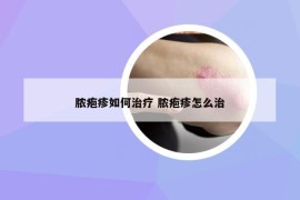 膿皰疹如何治療 膿皰疹怎么治
