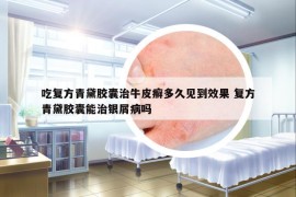 吃復(fù)方青黛膠囊治牛皮癬多久見到效果 復(fù)方青黛膠囊能治銀屑病嗎