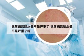 銀屑病流膿水是不是嚴重了 銀屑病流膿水是不是嚴重了呀