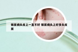 銀屑病頭皮上一直不好 銀屑病頭上好多頭皮屑