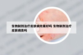生物制劑治療皮膚病效果好嗎 生物制劑治療皮膚病貴嗎