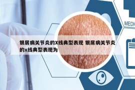 銀屑病關(guān)節(jié)炎的X線典型表現(xiàn) 銀屑病關(guān)節(jié)炎的x線典型表現(xiàn)為