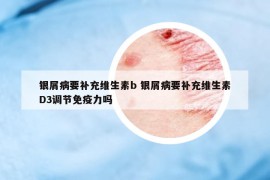 銀屑病要補充維生素b 銀屑病要補充維生素D3調(diào)節(jié)免疫力嗎