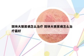斑塊大銀屑病怎么治療 斑塊大銀屑病怎么治療最好