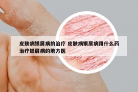 皮膚病銀屑病的治療 皮膚病銀屑病用什么藥治療銀屑病的地方醫(yī)
