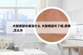 大腿根部長癬涂什么 大腿根部長了癬,很癢,怎么辦