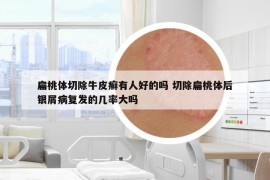 扁桃體切除牛皮癬有人好的嗎 切除扁桃體后銀屑病復(fù)發(fā)的幾率大嗎