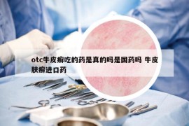 otc牛皮癬吃的藥是真的嗎是國藥嗎 牛皮膚癬進口藥